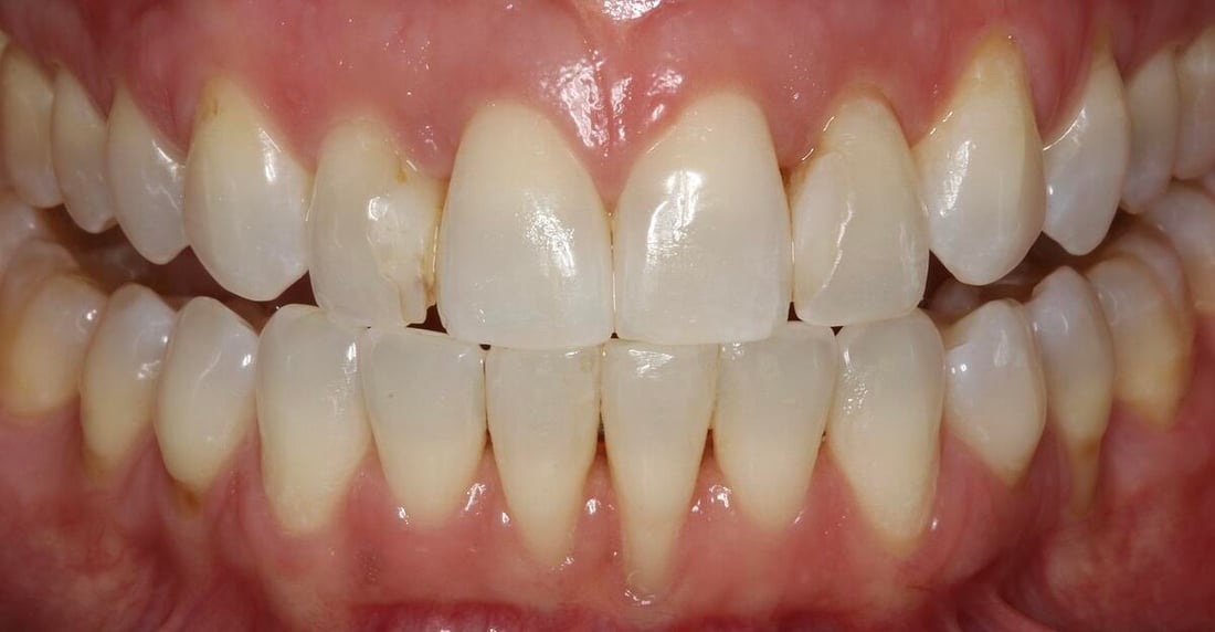 Delton Tatum before Emax Image 1