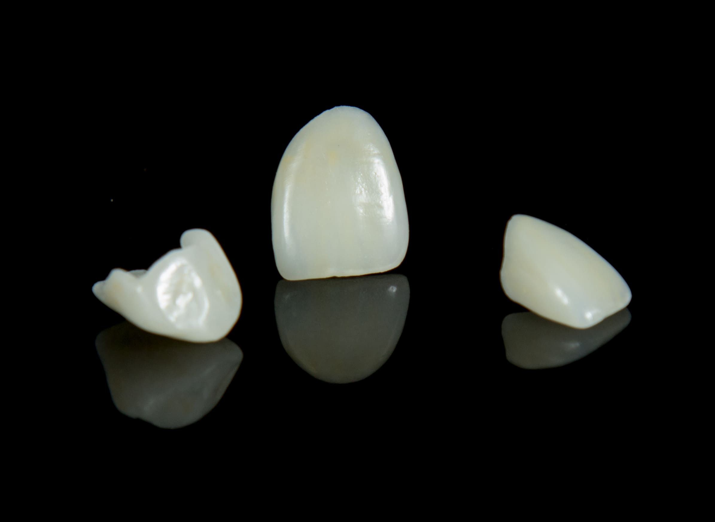 Emax veneers