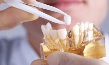 PFM vs. Zirconia