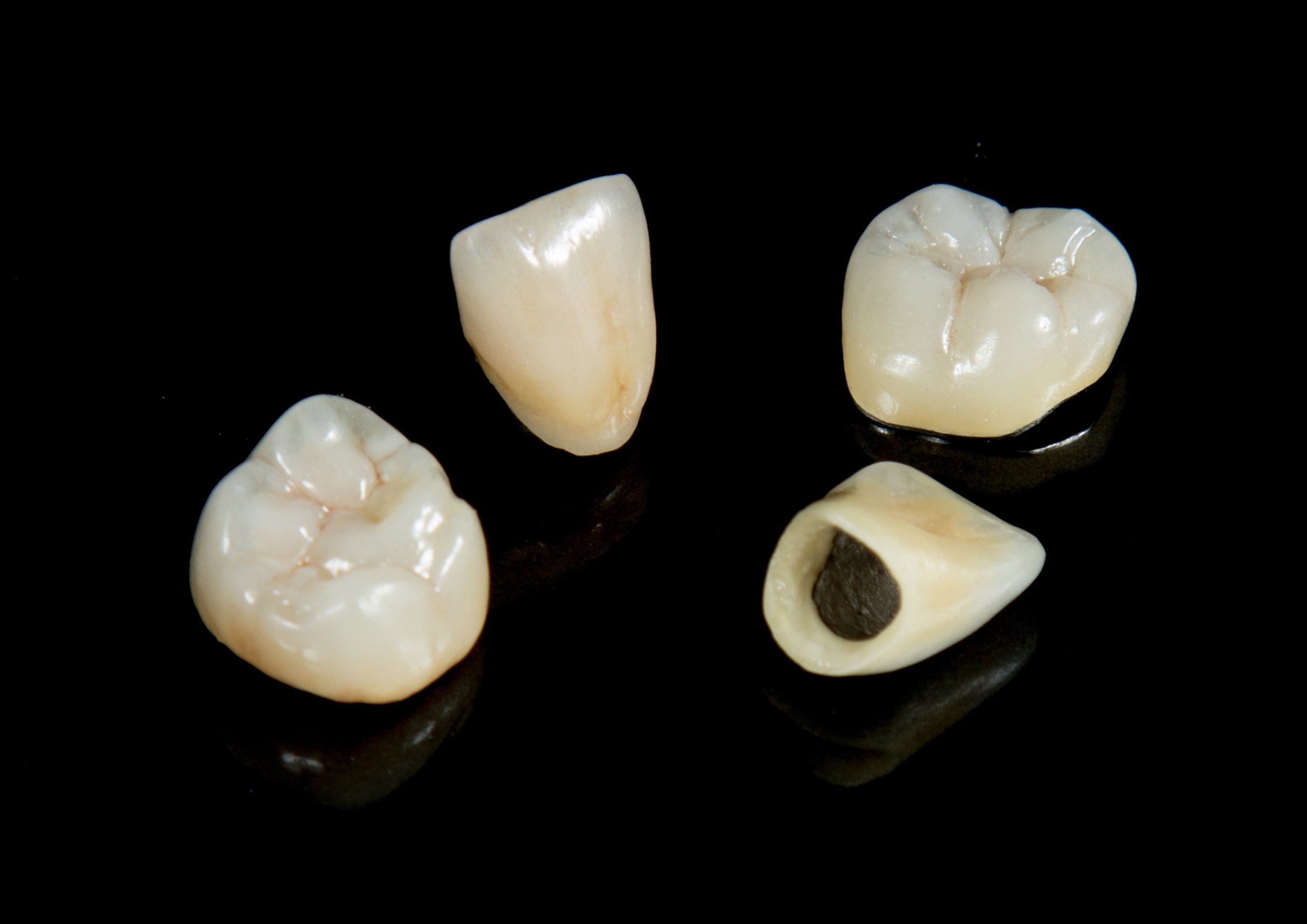PFM Crown & Bridges - Porcelain Fused to Metal Restorations | Pro-Craft