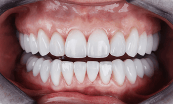 aesthetic anterior crown