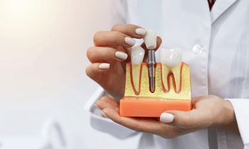 screw-retained and cemented implants