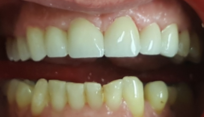 After Beautiful case on 6-11 featuring All-Z Plus translucent zirconia, which provides the look of pressed ceramic and the strength of solid zirconia. | Pro-Craft