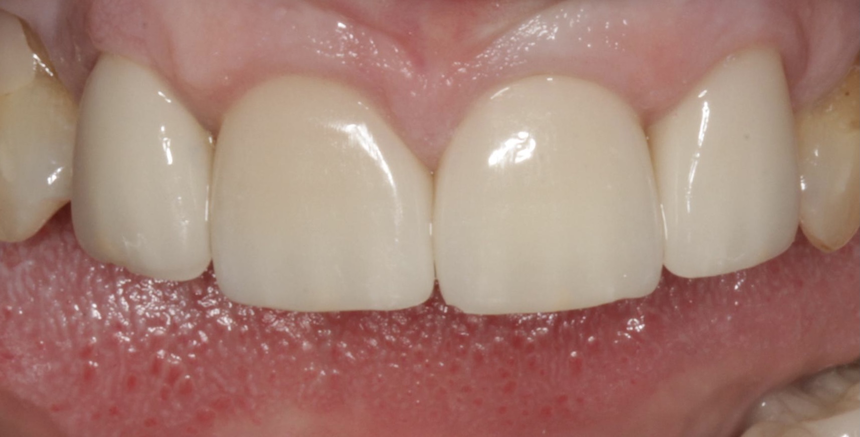 Patient case features PRO-Craft All-Z Zirconia on 7-10.  ALL-Z offers approximately 1400 in MPA strength and a conditional lifetime guarantee against breakage. | Pro-Craft