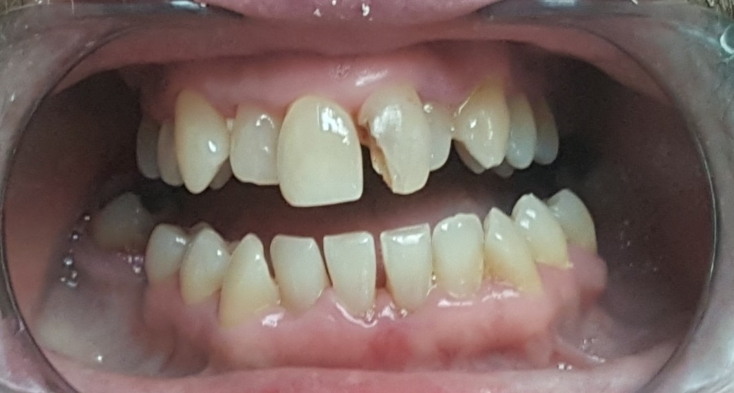 Patient presents with need for near full mouth restoration. | Pro-Craft