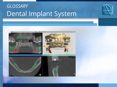  What are Implant Systems in Dentistry?  | Pro-Craft