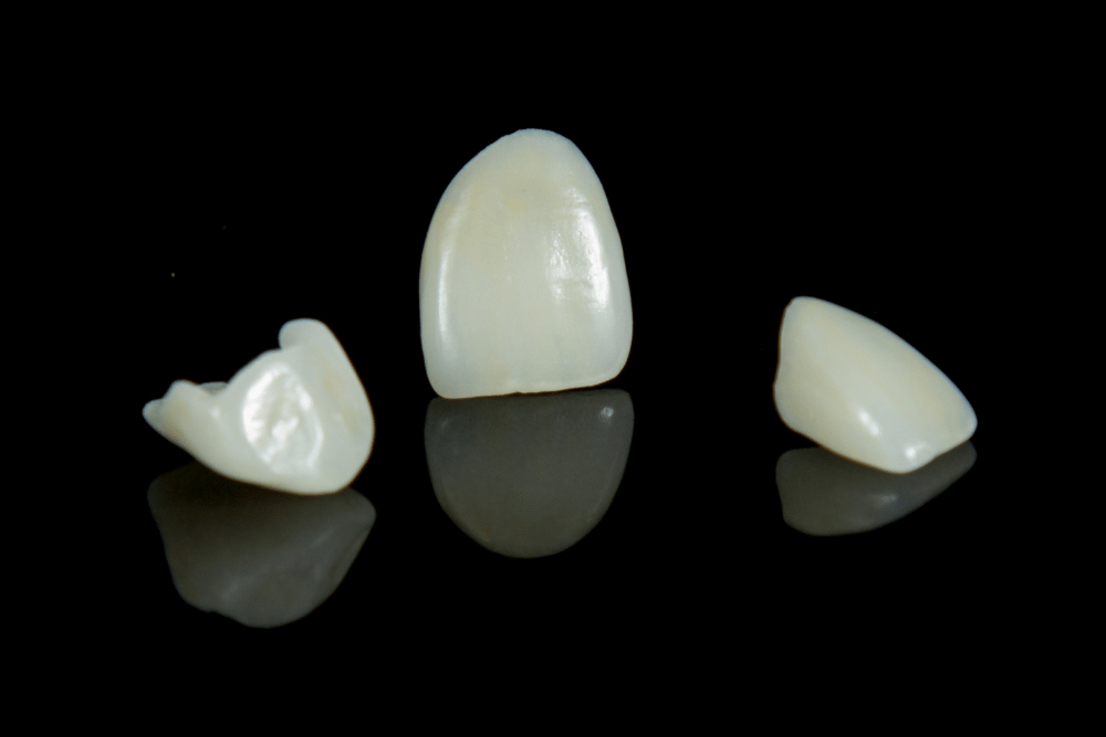 IPS e.max® Layered Veneers