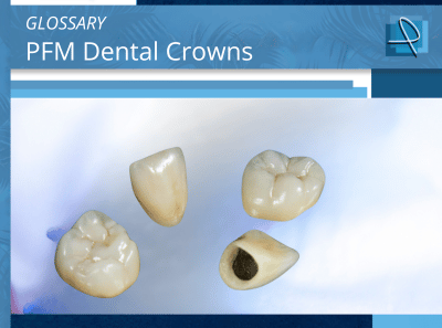 What Is a Porcelain Fused to Metal Dental Crown? | Pro-Craft