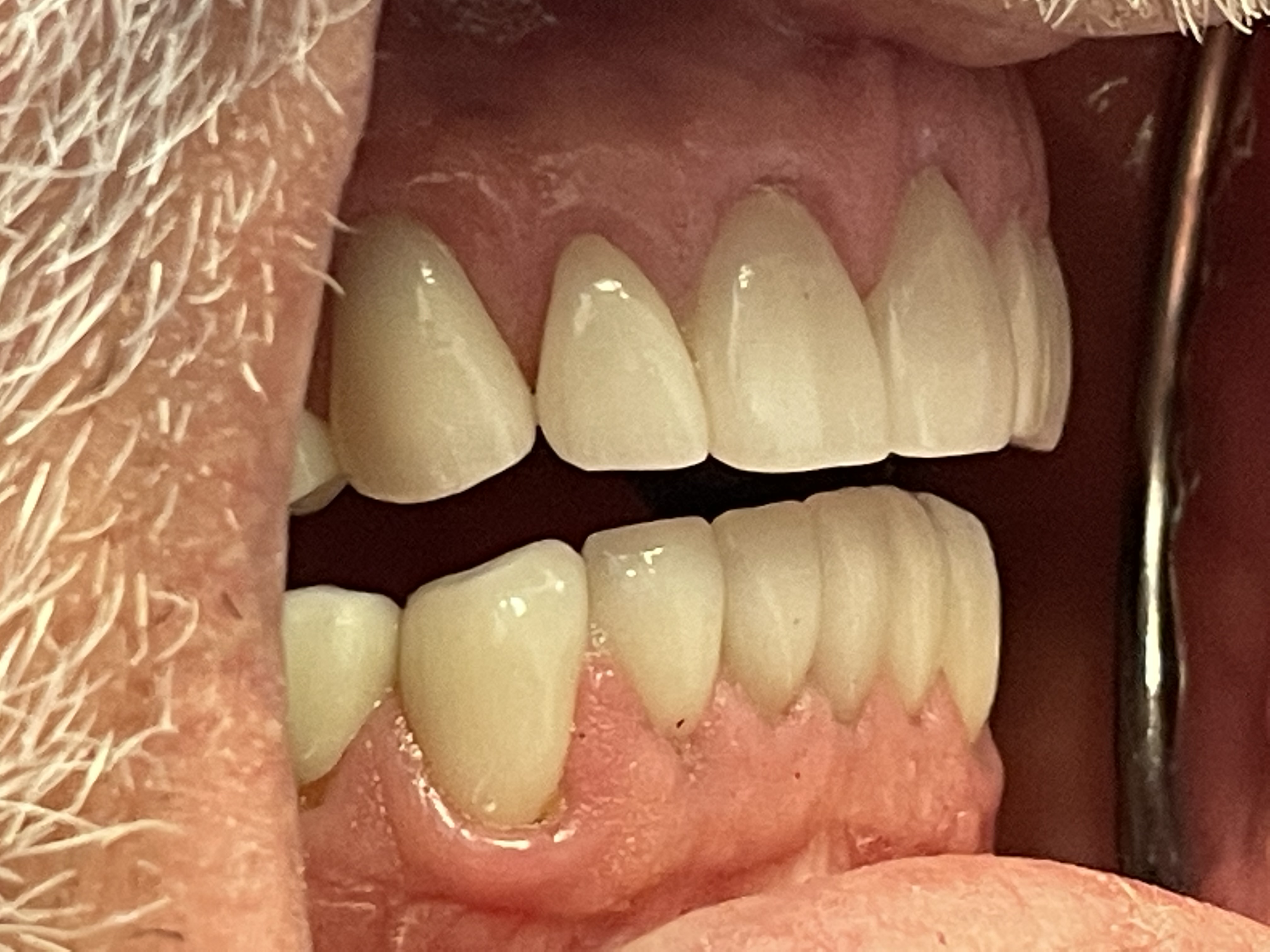 Patient requested a full mouth restoration. | Pro-Craft