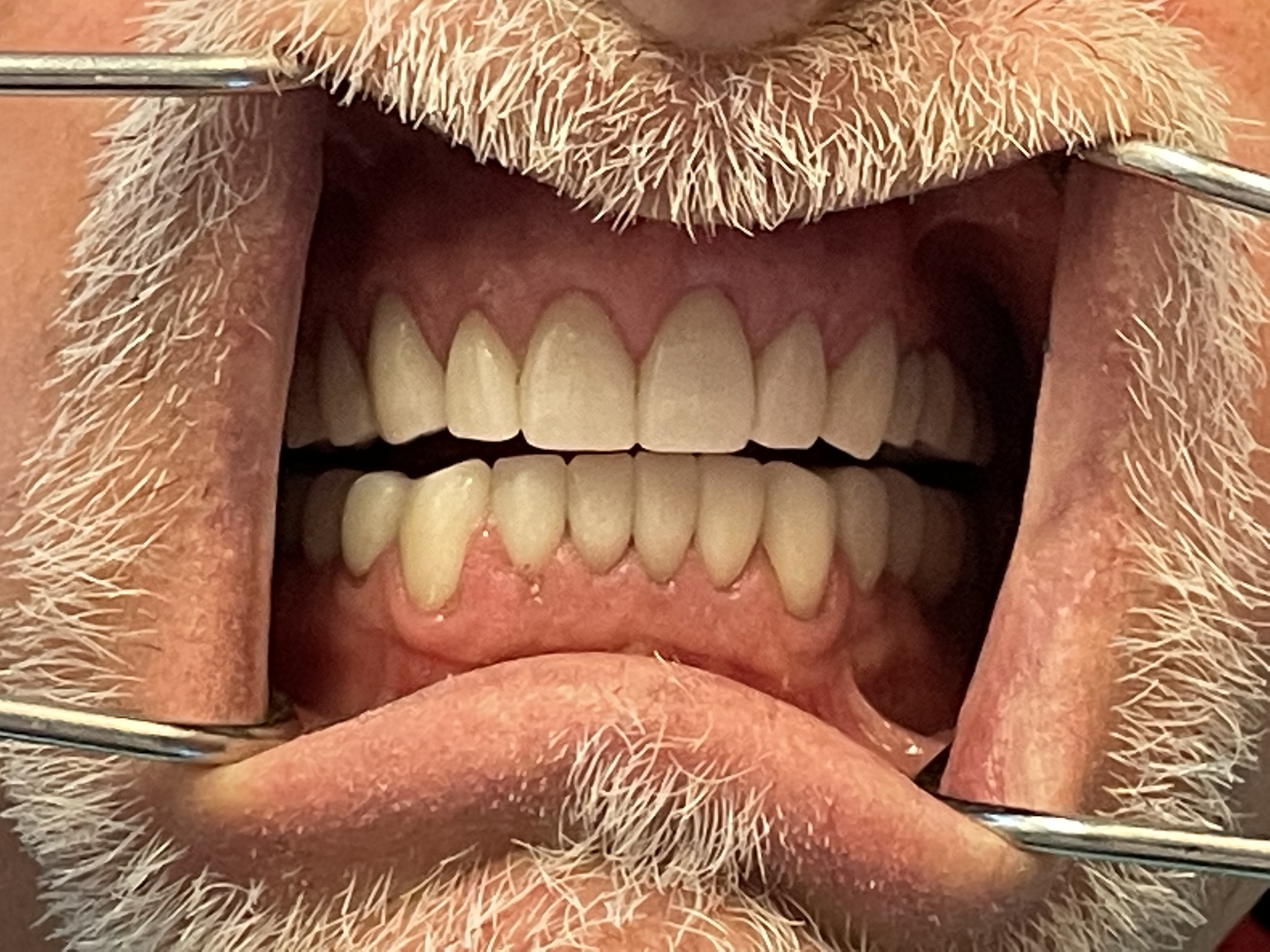 After Patient requested a full mouth restoration. | Pro-Craft