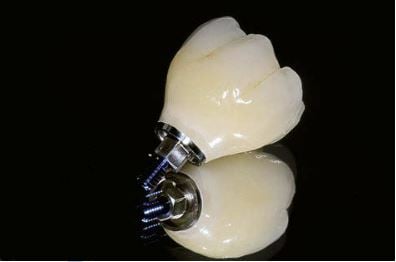 Screw Retained Prosthetic