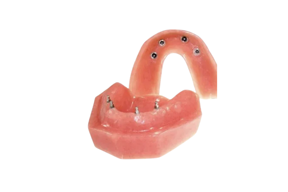 Mini Implant from PRO-Craft Dental Laboratory