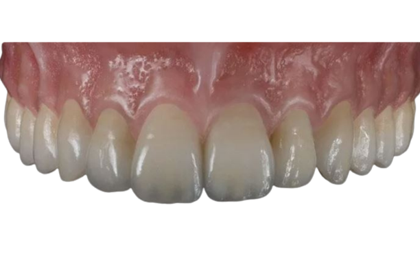 ALL-Z Plus Translucent Solid Zirconia Teeth from PRO-Craft Dental Laboratory