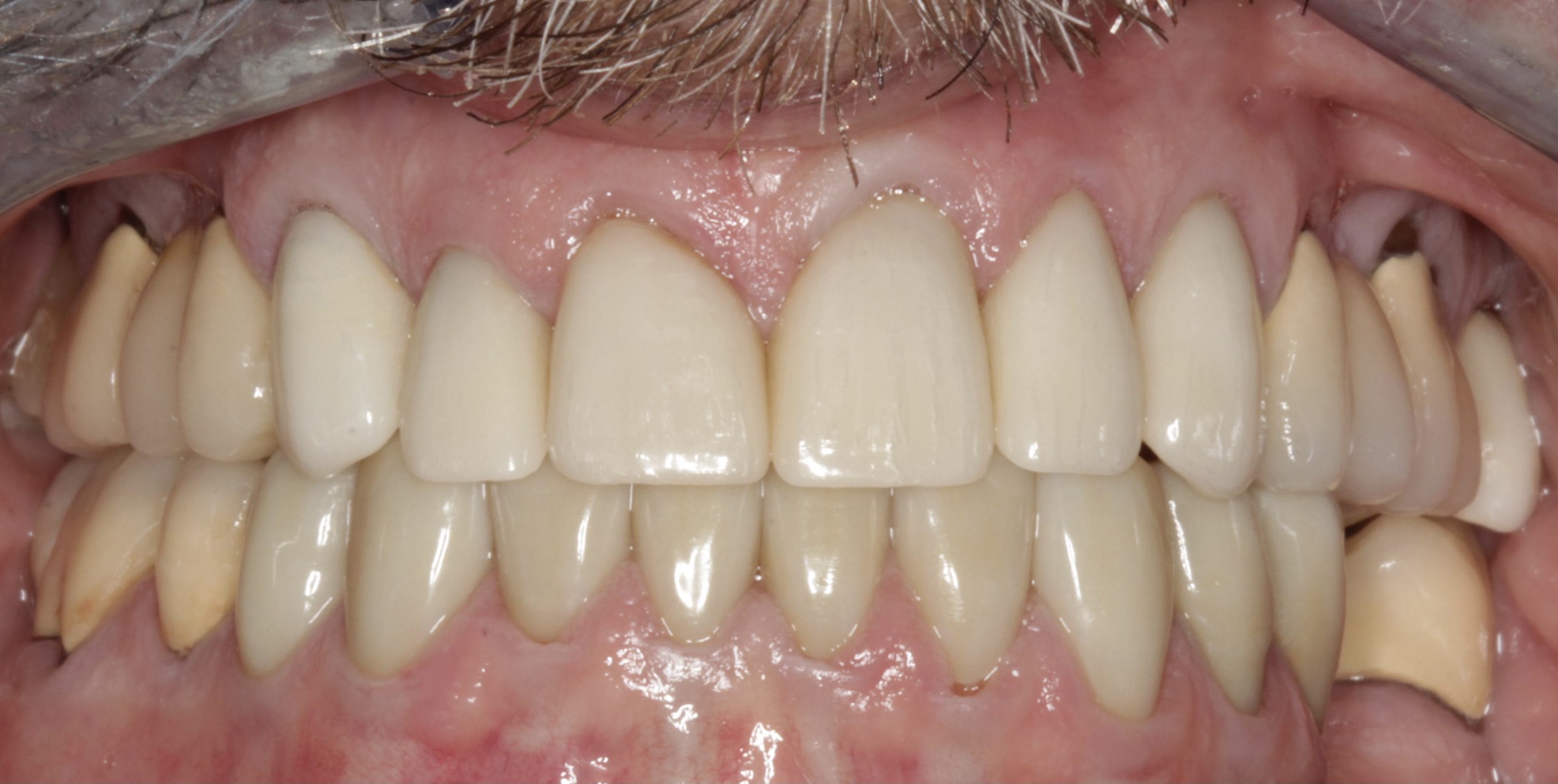 After Patient case features All-Z crown restorations on 6-11 and 22-28.  All-Z is a full contour 100% zirconia crown and bridge material designed and milled utilizing CAD/CAM technology with no porcelain overlay. | Pro-Craft