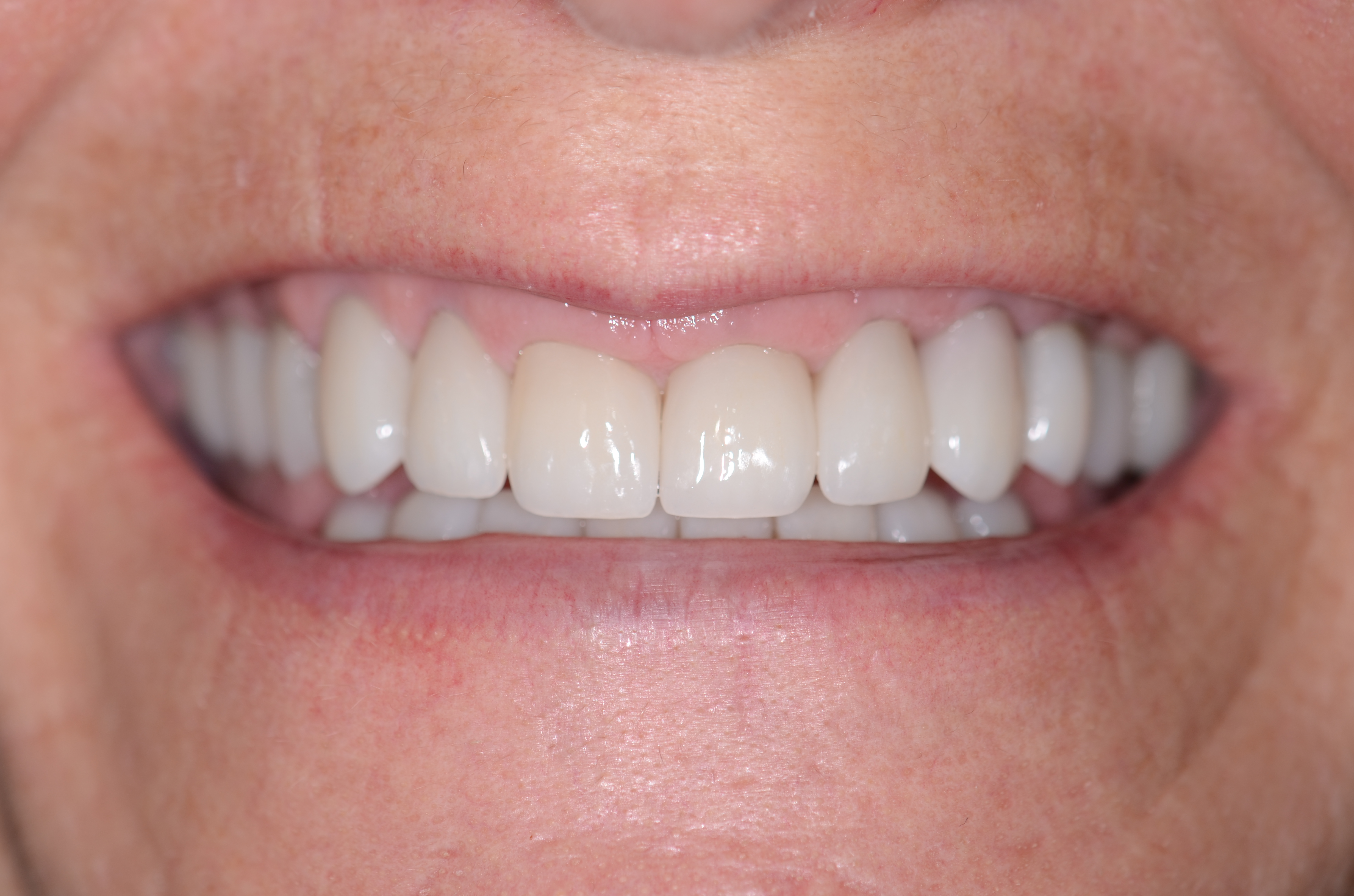 Patient case features full mouth restoration using All-Z Plus multi-layered translucent zirconia to closely replicate the esthetics of a natural tooth. | Pro-Craft