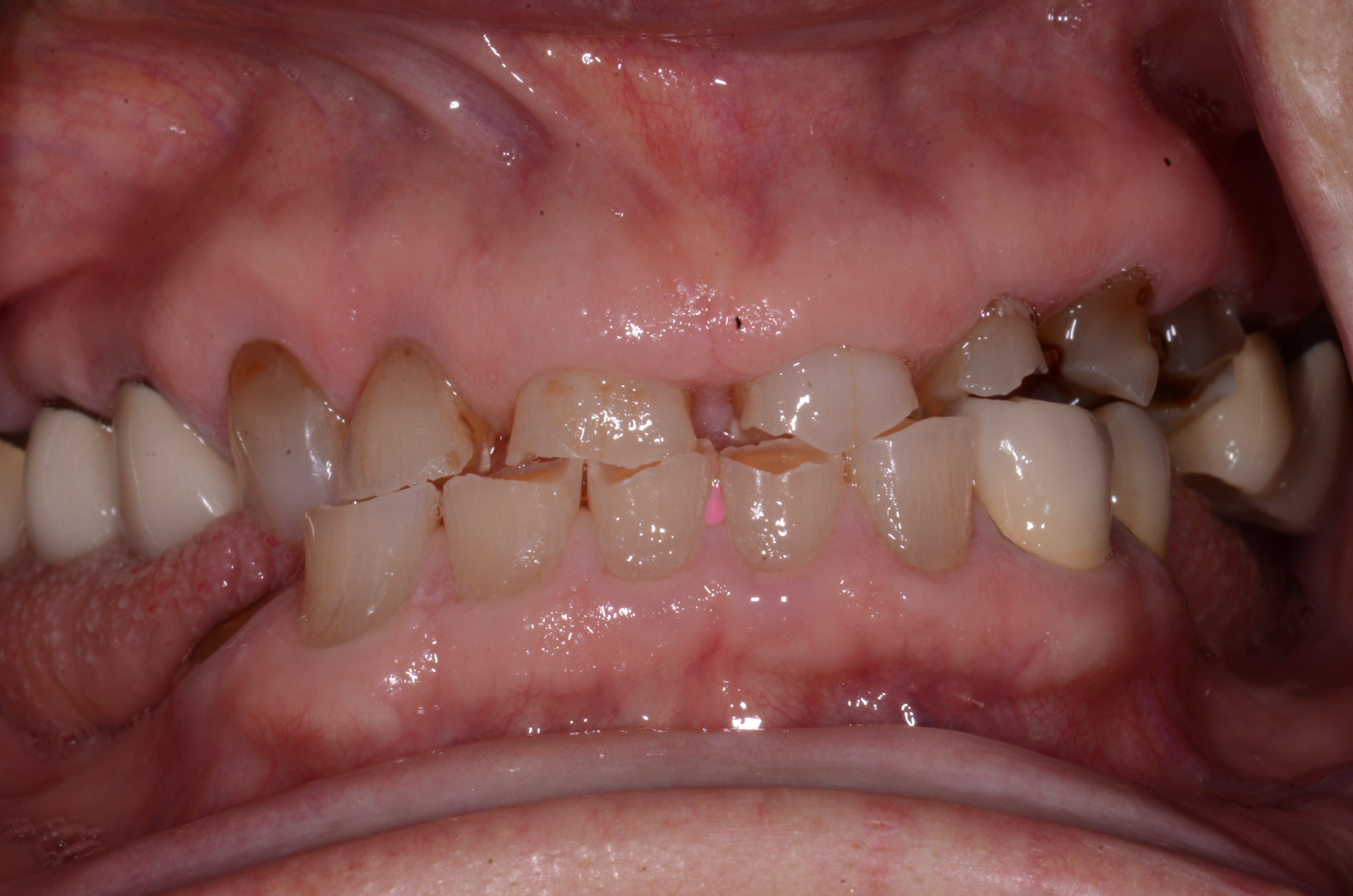 Before  Patient requested a full mouth restoration. | Pro-Craft