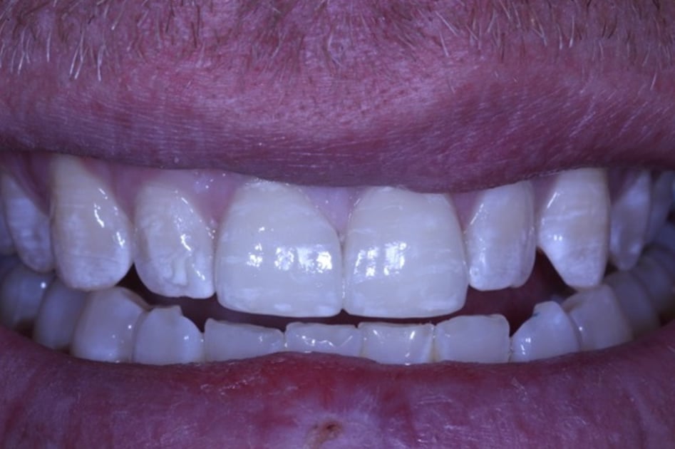 After This beautiful case features Emax crowns!. Emax dental restorations are most preferred on vital teeth to achieve maximum esthetic results. | Pro-Craft