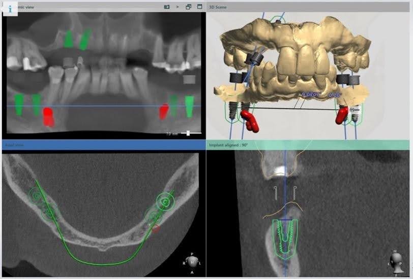 Surgical Guide for Dental Implants