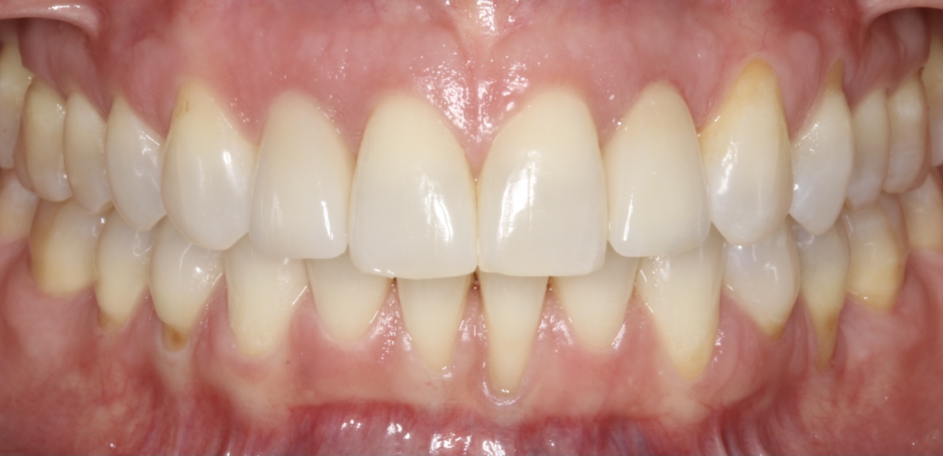 After Crown and bridge restorations hand layered with emax on teeth 7-10  | Pro-Craft